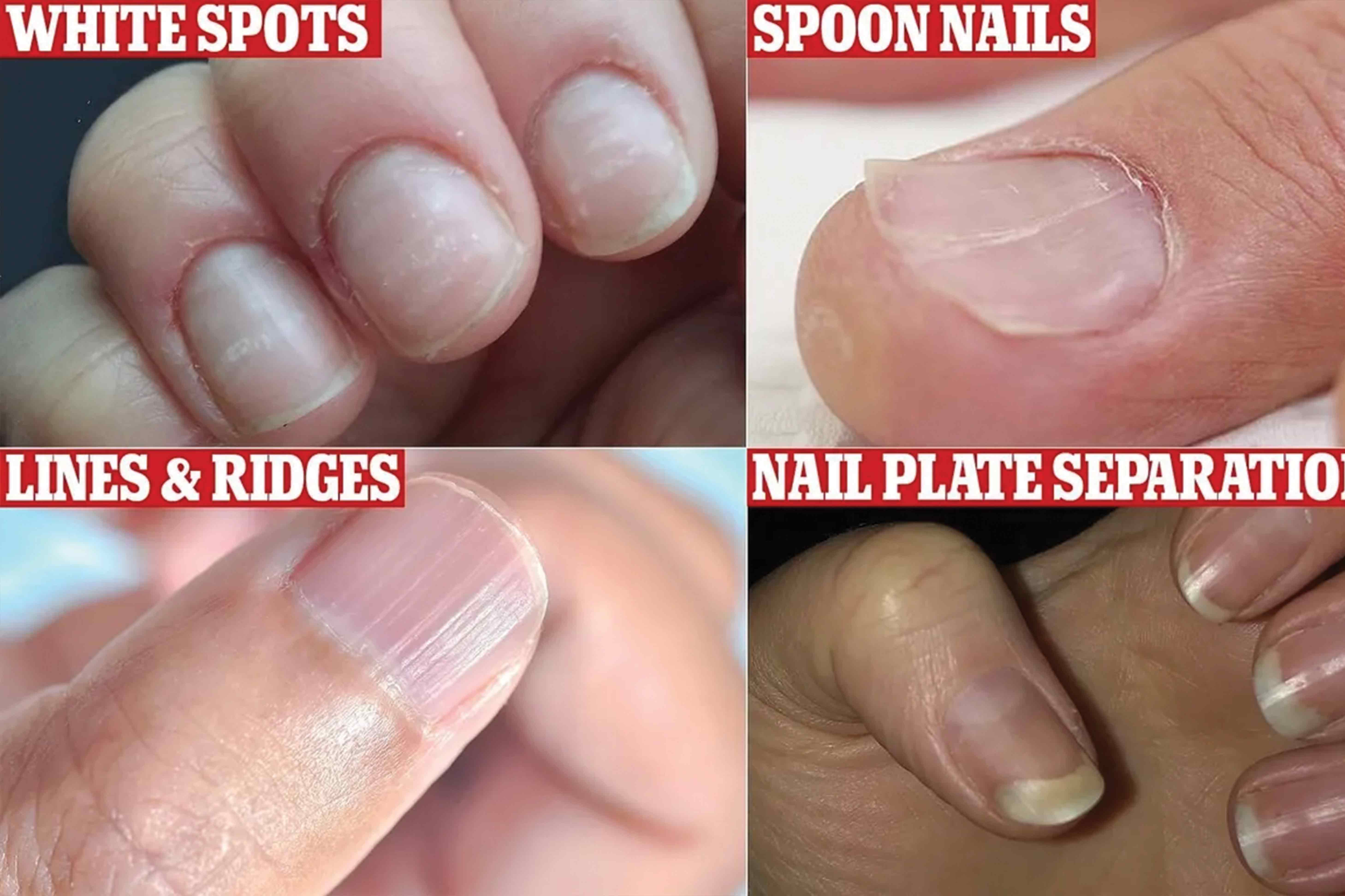 Nail Care Cracking the Code of Vitamin B12 Deficiency StyleSpeak